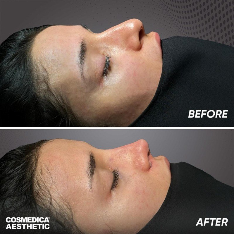 Why Choose Turkey for Rhinoplasty? 